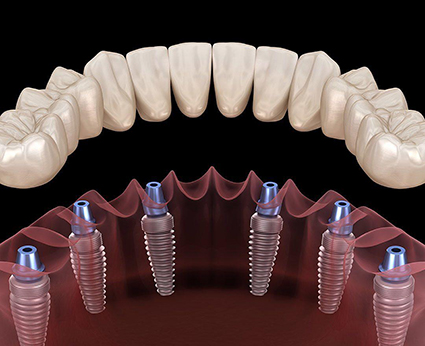 ÜNLÜ DİŞ HEKİMİ YAŞAR ÖZDEMİR İMPLANT HAKKINDA MERAK EDİLENLERİ ANLATTI