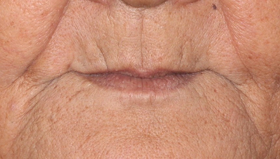 İLERİ DERECEDE KEMİK KAYBI OLAN ÇENELERDE ALTERNATİF TEDAVİ YAKLAŞIMI: ALL-ON-4 KONSEPTİ